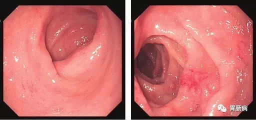 萎縮性胃炎不可怕，只要真正了解它